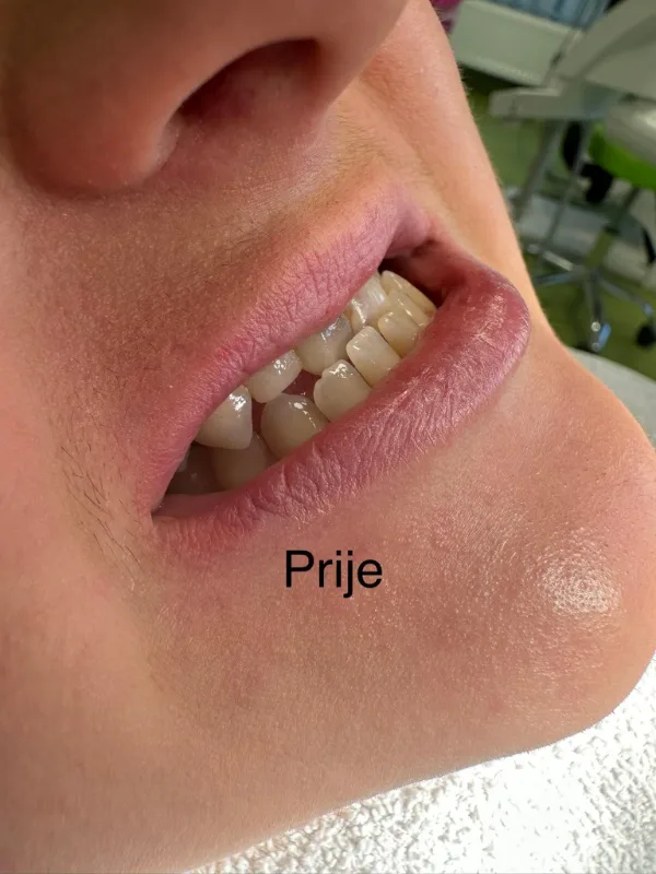 Prije: zubi prije zahvata, snimljeni iz profila